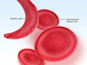 Diagram of sickle cell